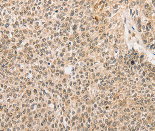 Immunohistochemistry of paraffin-embedded Human lung cancer tissue using RPL26L1 Polyclonal Antibody at dilution 1:30