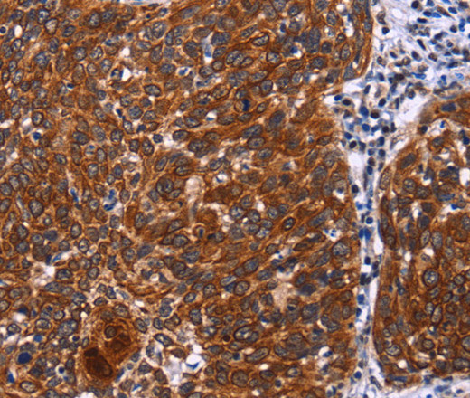 Immunohistochemistry of paraffin-embedded Human cervical cancer tissue using USP2 Polyclonal Antibody at dilution 1:40