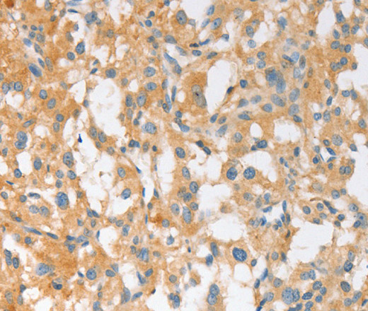 Immunohistochemistry of paraffin-embedded Human thyroid cancer using EPS15L1 Polyclonal Antibody at dilution of 1:30