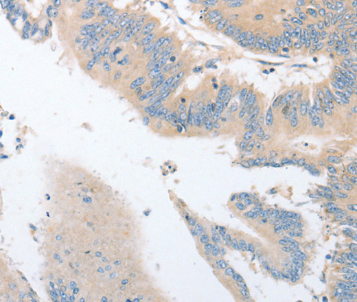 Immunohistochemistry of paraffin-embedded Human colon cancer using EPS15L1 Polyclonal Antibody at dilution of 1:30