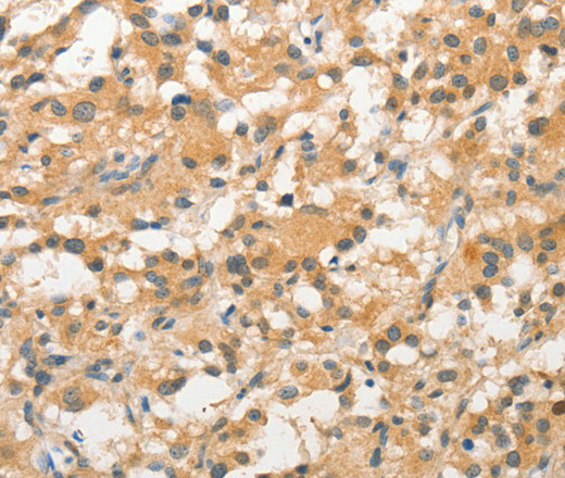 Immunohistochemistry of paraffin-embedded Human thyroid cancer tissue using STAM Polyclonal Antibody at dilution 1:40