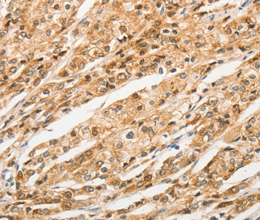 Immunohistochemistry of paraffin-embedded Human prostate cancer tissue using STAM Polyclonal Antibody at dilution 1:40