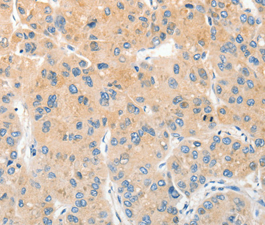 Immunohistochemistry of paraffin-embedded Human liver cancer using RPN1 Polyclonal Antibody at dilution of 1:30