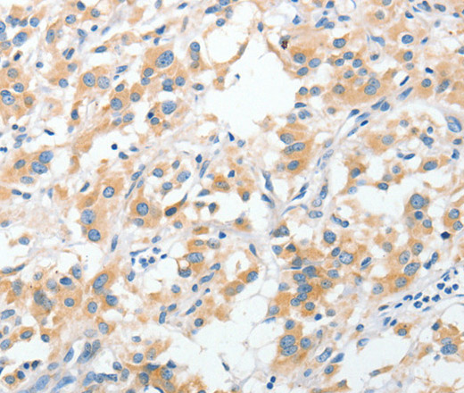 Immunohistochemistry of paraffin-embedded Human thyroid cancer using RPN1 Polyclonal Antibody at dilution of 1:30