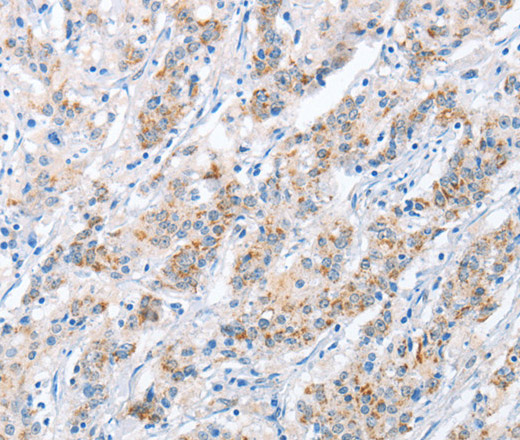 Immunohistochemistry of paraffin-embedded Human gastric cancer tissue using PAPSS1 Polyclonal Antibody at dilution 1:40