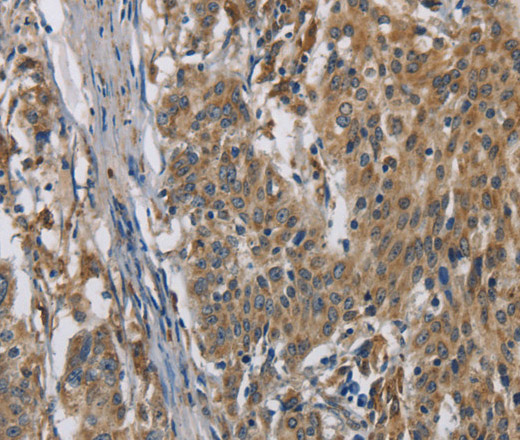 Immunohistochemistry of paraffin-embedded Human gastic cancer using SIGMAR1 Polyclonal Antibody at dilution of 1:50