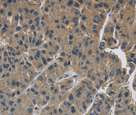 Immunohistochemistry of paraffin-embedded Human liver cancer using SIGMAR1 Polyclonal Antibody at dilution of 1:50