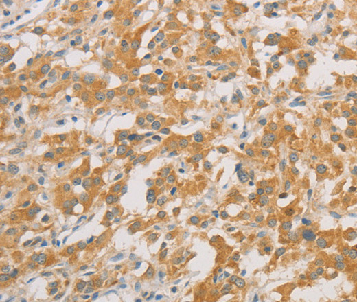 Immunohistochemistry of paraffin-embedded Human thyroid cancer tissue using ZWINT Polyclonal Antibody at dilution 1:50