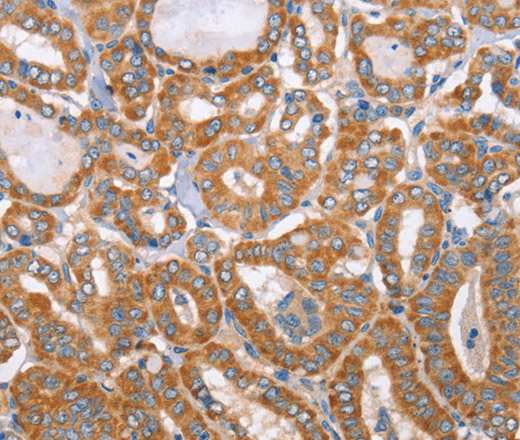 Immunohistochemistry of paraffin-embedded Human thyroid cancer tissue using MTMR7 Polyclonal Antibody at dilution 1:40