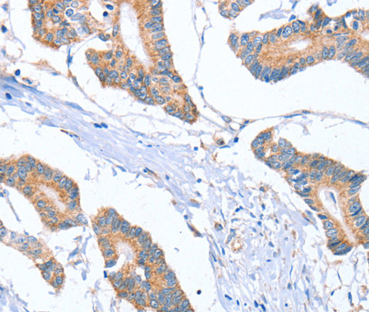 Immunohistochemistry of paraffin-embedded Human colon cancer tissue using MTMR7 Polyclonal Antibody at dilution 1:40