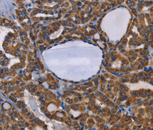 Immunohistochemistry of paraffin-embedded Human thyroid cancer tissue using GRK3 Polyclonal Antibody at dilution 1:50
