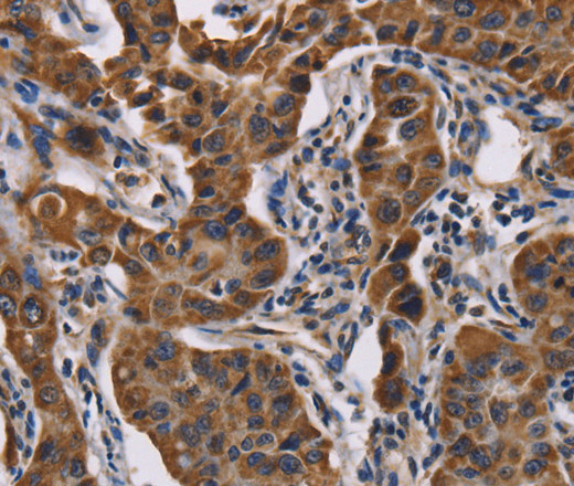 Immunohistochemistry of paraffin-embedded Human lung cancer tissue using GRK3 Polyclonal Antibody at dilution 1:50