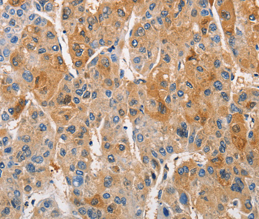 Immunohistochemistry of paraffin-embedded Human liver cancer using PKC epsilon Polyclonal Antibody at dilution of 1:50