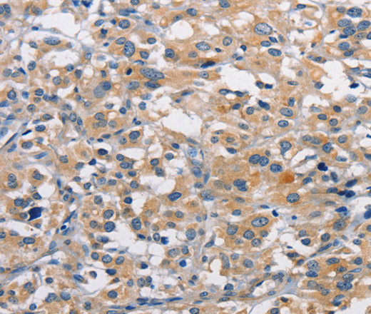 Immunohistochemistry of paraffin-embedded Human thyroid cancer using PKC epsilon Polyclonal Antibody at dilution of 1:50