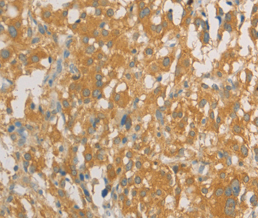 Immunohistochemistry of paraffin-embedded Human thyroid cancer tissue using PRPSAP1 Polyclonal Antibody at dilution 1:80