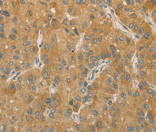 Immunohistochemistry of paraffin-embedded Human liver cancer tissue using PRPSAP1 Polyclonal Antibody at dilution 1:80
