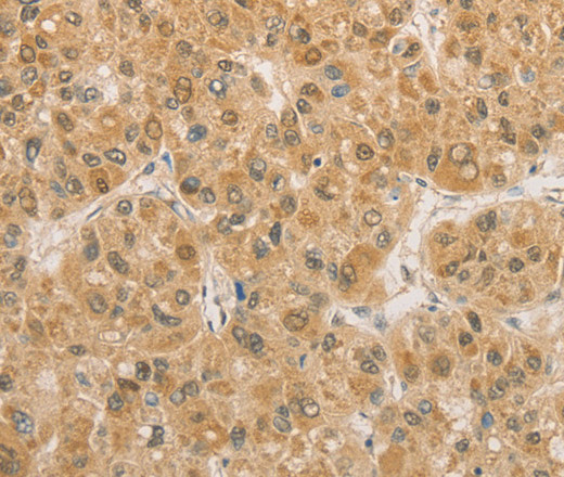 Immunohistochemistry of paraffin-embedded Human liver cancer using PGK2 Polyclonal Antibody at dilution of 1:50