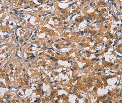 Immunohistochemistry of paraffin-embedded Human thyroid cancer tissue using PIKFYVE Polyclonal Antibody at dilution 1:50