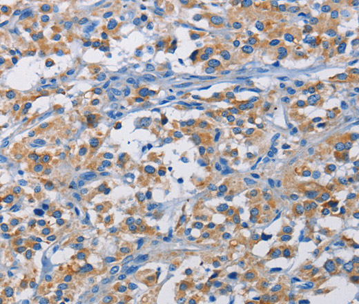 Immunohistochemistry of paraffin-embedded Human thyroid cancer tissue using RICTOR Polyclonal Antibody at dilution 1:50