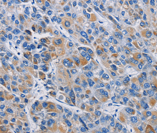 Immunohistochemistry of paraffin-embedded Human liver cancer tissue using RICTOR Polyclonal Antibody at dilution 1:50