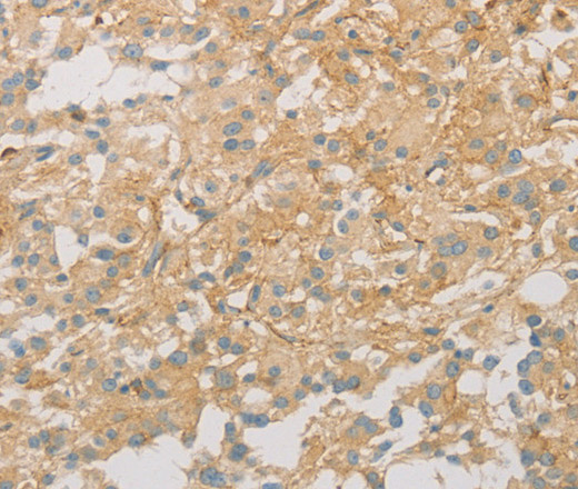 Immunohistochemistry of paraffin-embedded Human thyroid cancer tissue using VTN Polyclonal Antibody at dilution 1:40