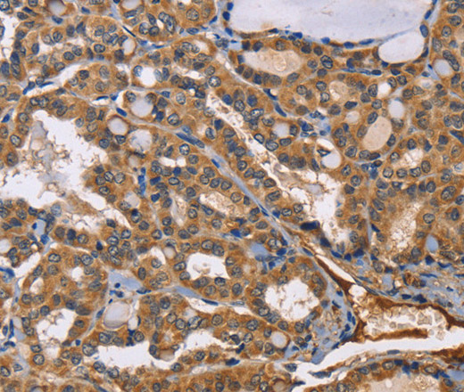 Immunohistochemistry of paraffin-embedded Human thyroid cancer tissue using EPHB6 Polyclonal Antibody at dilution 1:50