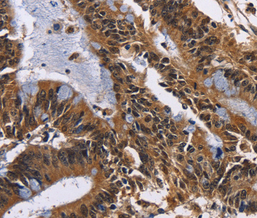 Immunohistochemistry of paraffin-embedded Human colon cancer tissue using EPHB6 Polyclonal Antibody at dilution 1:50