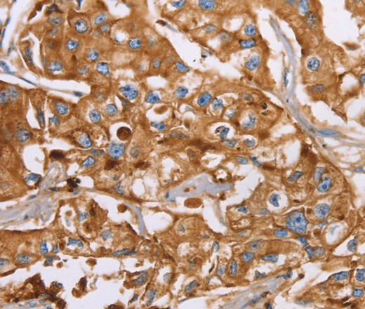 Immunohistochemistry of paraffin-embedded Human breast cancer using LTF Polyclonal Antibody at dilution of 1:40