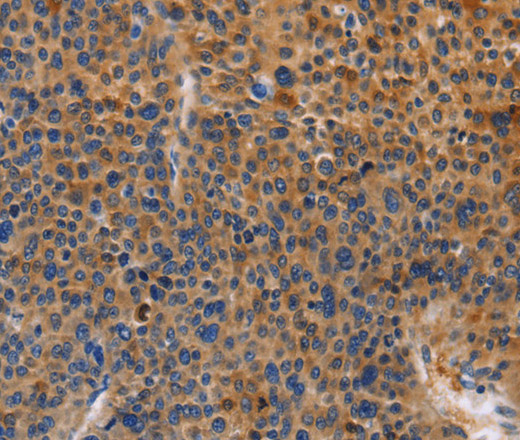 Immunohistochemistry of paraffin-embedded Human liver cancer tissue using MUSK Polyclonal Antibody at dilution of 1:30