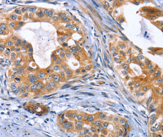 Immunohistochemistry of paraffin-embedded Human cervical cancer using MUSK Polyclonal Antibody at dilution of 1:30