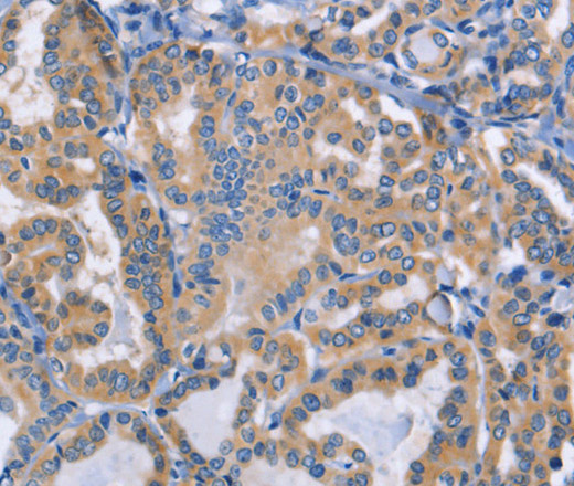 Immunohistochemistry of paraffin-embedded Human thyroid cancer tissue using DOK4 Polyclonal Antibody at dilution 1:50
