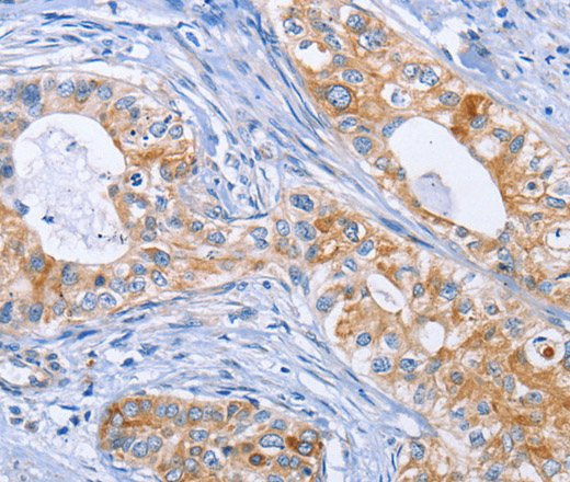 Immunohistochemistry of paraffin-embedded Human cervical cancer tissue using DOK4 Polyclonal Antibody at dilution 1:50