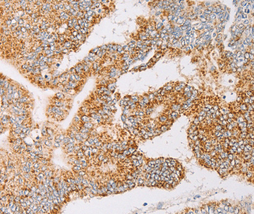 Immunohistochemistry of paraffin-embedded Human colon cancer tissue using YARS2 Polyclonal Antibody at dilution 1:30