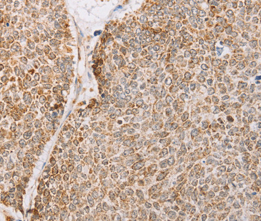 Immunohistochemistry of paraffin-embedded Human lung cancer tissue using YARS2 Polyclonal Antibody at dilution 1:30