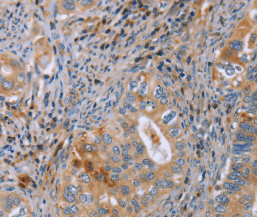 Immunohistochemistry of paraffin-embedded Human cervical cancer using GMFG Polyclonal Antibody at dilution of 1:50