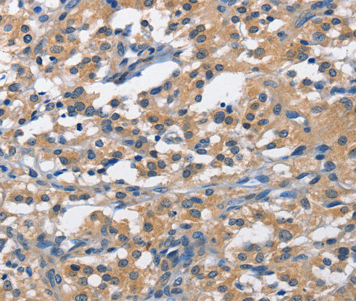 Immunohistochemistry of paraffin-embedded Human thyroid cancer tissue using PIM1 Polyclonal Antibody at dilution 1:40