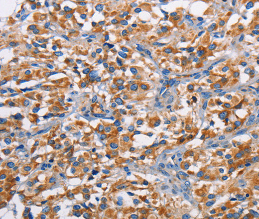 Immunohistochemistry of paraffin-embedded Human thyroid cancer tissue using PIM2 Polyclonal Antibody at dilution 1:40