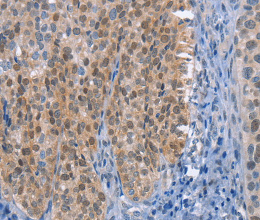 Immunohistochemistry of paraffin-embedded Human cervical cancer tissue using UCK1 Polyclonal Antibody at dilution 1:50