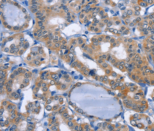 Immunohistochemistry of paraffin-embedded Human thyroid cancer tissue using UCK1 Polyclonal Antibody at dilution 1:50