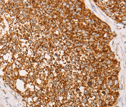 Immunohistochemistry of paraffin-embedded Human cervical cancer using AK2 Polyclonal Antibody at dilution of 1:40