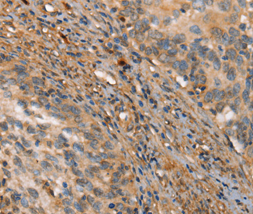 Immunohistochemistry of paraffin-embedded Human cervical cancer tissue using HK3 Polyclonal Antibody at dilution 1:40