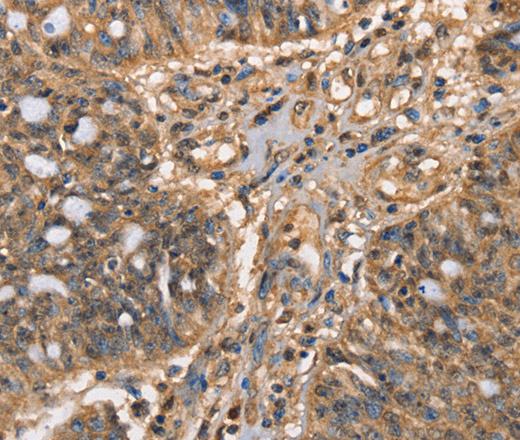 Immunohistochemistry of paraffin-embedded Human ovarian cancer tissue using HK3 Polyclonal Antibody at dilution 1:40