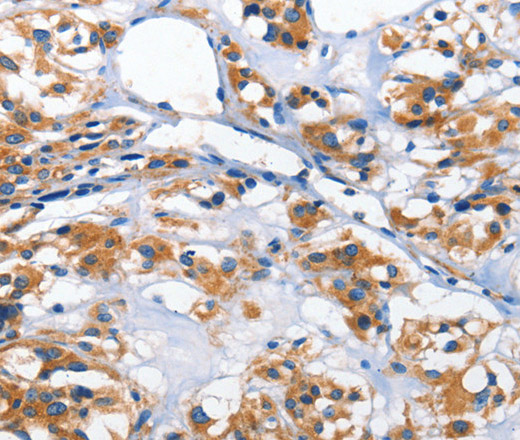 Immunohistochemistry of paraffin-embedded Human thyroid cancer tissue using HK2 Polyclonal Antibody at dilution 1:40