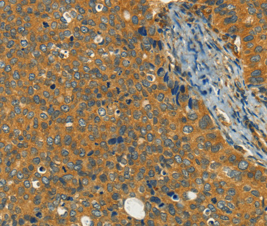 Immunohistochemistry of paraffin-embedded Human cervical cancer using KLC1 Polyclonal Antibody at dilution of 1:40