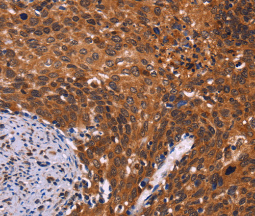 Immunohistochemistry of paraffin-embedded Human cervical cancer tissue using CDC5L Polyclonal Antibody at dilution 1:40