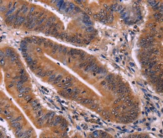 Immunohistochemistry of paraffin-embedded Human colon cancer tissue using CDC5L Polyclonal Antibody at dilution 1:40