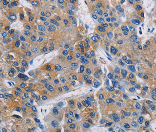 Immunohistochemistry of paraffin-embedded Human liver cancer using GPM6A Polyclonal Antibody at dilution of 1:40