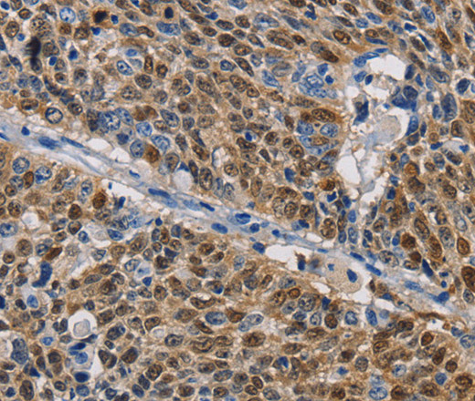 Immunohistochemistry of paraffin-embedded Human lung cancer tissue using GSTA2 Polyclonal Antibody at dilution 1:50