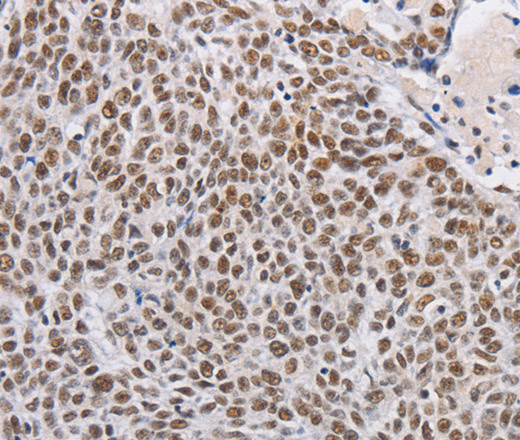 Immunohistochemistry of paraffin-embedded Human lung cancer using THOC7 Polyclonal Antibody at dilution of 1:30