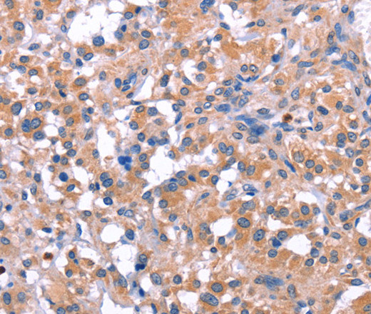 Immunohistochemistry of paraffin-embedded Human thyroid cancer tissue using ELP2 Polyclonal Antibody at dilution 1:40